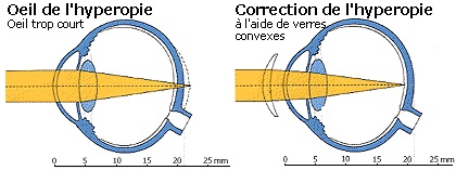 oeil hypermetrope