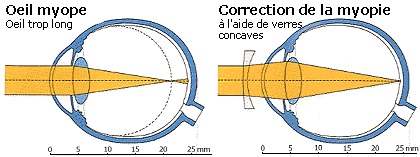 oeil myope