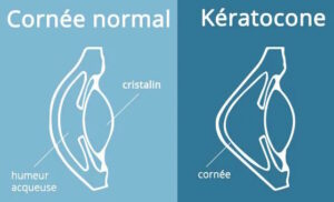 keratocone