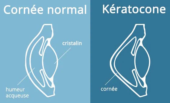 keratocone